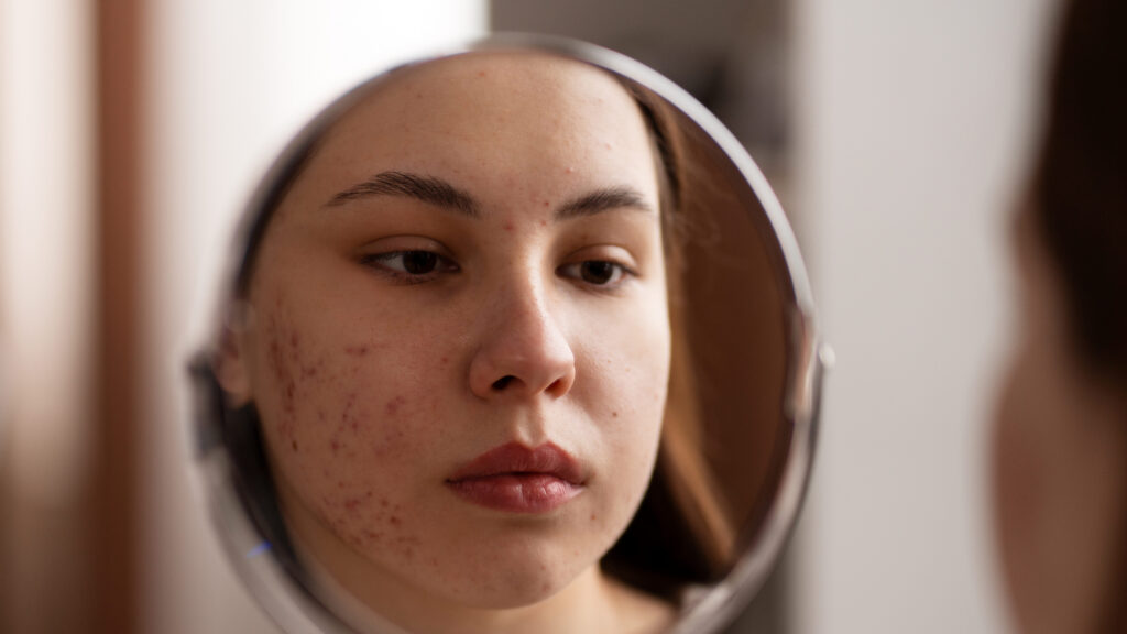How to Get Rid of Acne Scars: What Actually Works